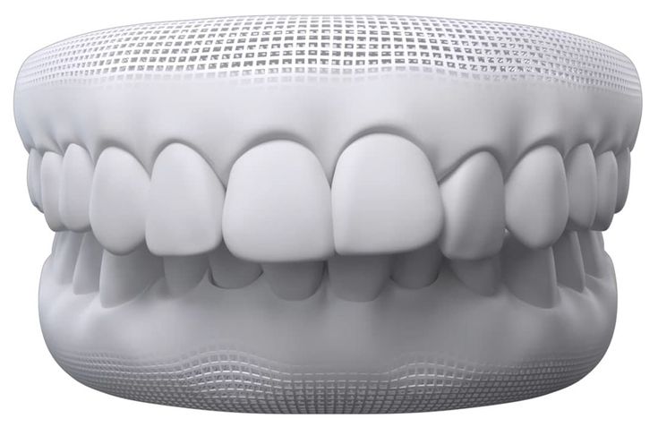 3D dental model showing an overbite