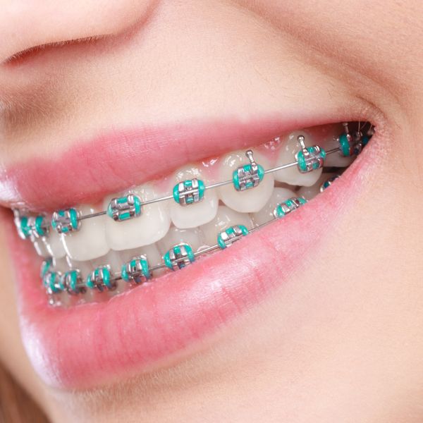 Clear aligner and orthodontic care