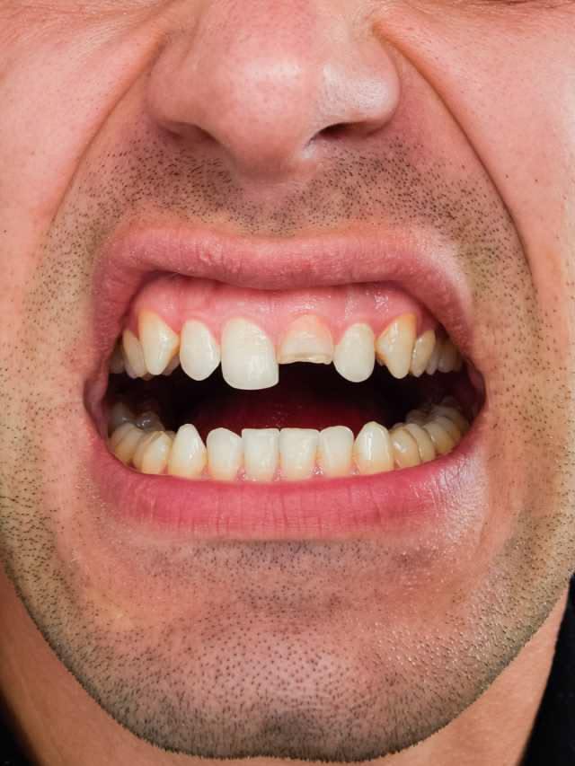 Emergency tooth extraction