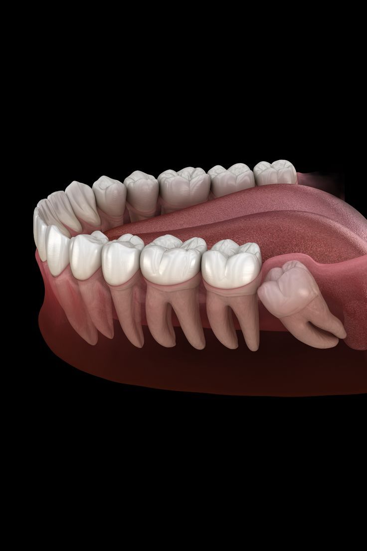 Wisdom tooth removal