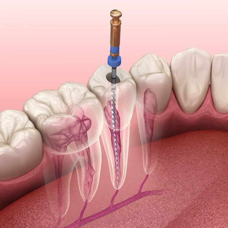 Root canal treatment diagram