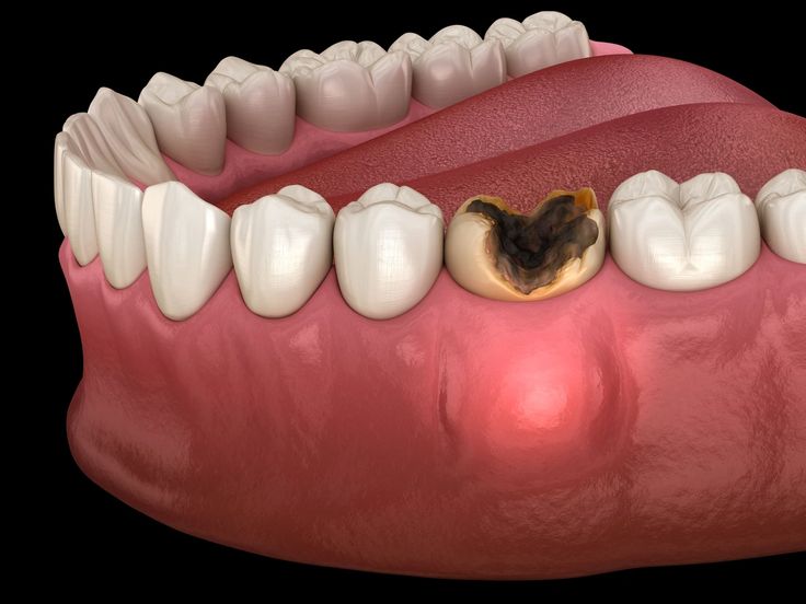 Tooth abscess