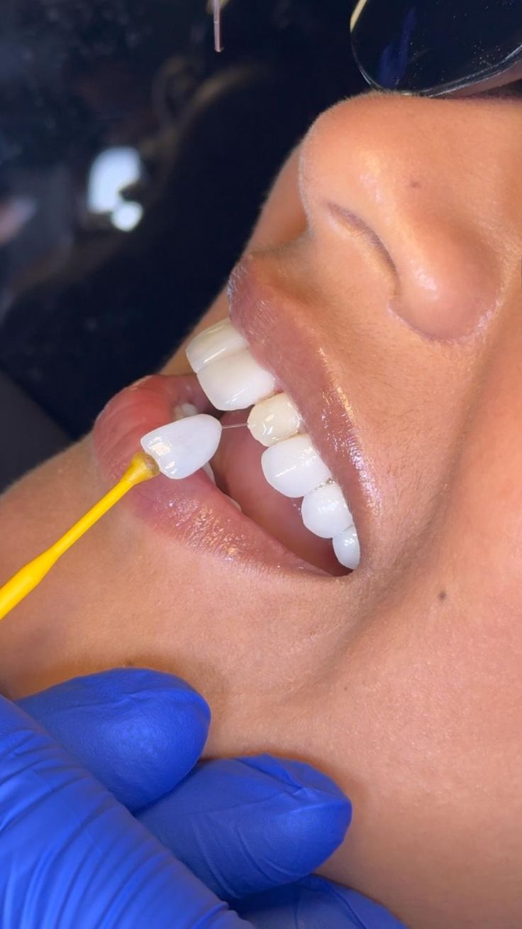 Dental veneer model